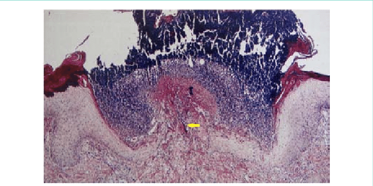 Histopathology Showing Prominent Epidermal Hyperplasia - Epidermis (744x371), Png Download