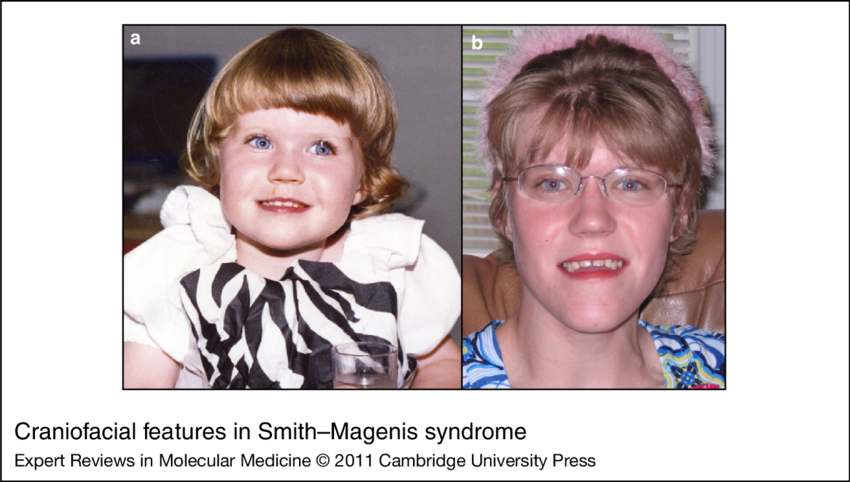 Download - Smith Magenis (850x482), Png Download