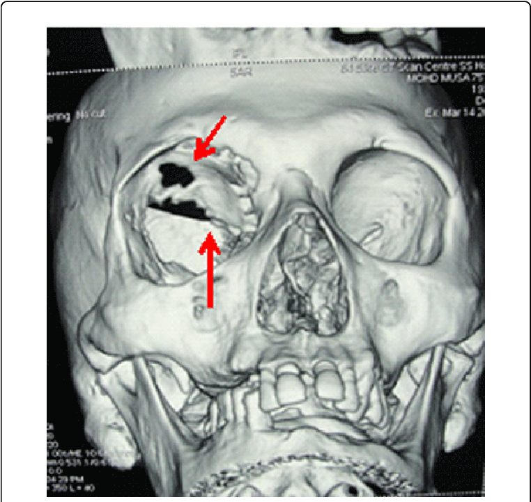 3 'd' Ct Image Showing Destruction Of Right - Sphenoid Bone (769x724), Png Download