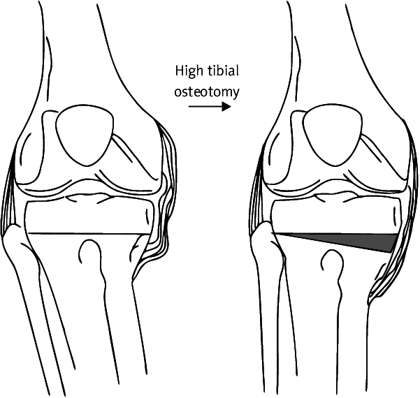 Example Of High Tibial Osteotomy Used For Varus Knee - High Tibial Osteotomy (601x570), Png Download