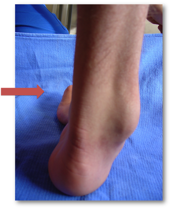 Charcot Marie Tooth Heel Varus - Thickened Nerves Charcot Marie Tooth (600x735), Png Download