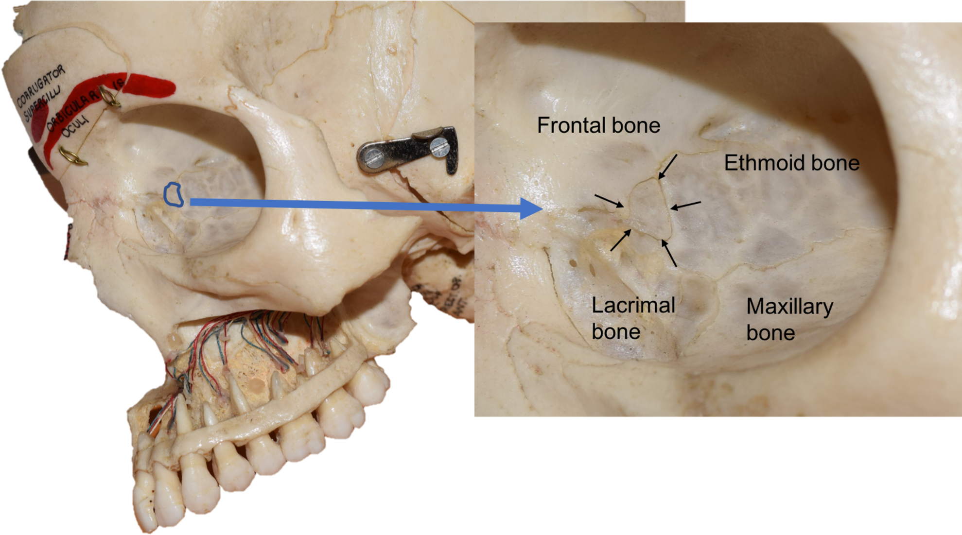The Wormian Bone Is Outlined On The Left In Blue - Lacrimal And Ethmoid Bone (2000x1126), Png Download