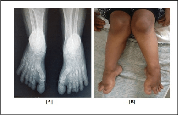 A] Knock Knee/genu Valgum B] X Ray Foot Showing Short (766x498), Png Download