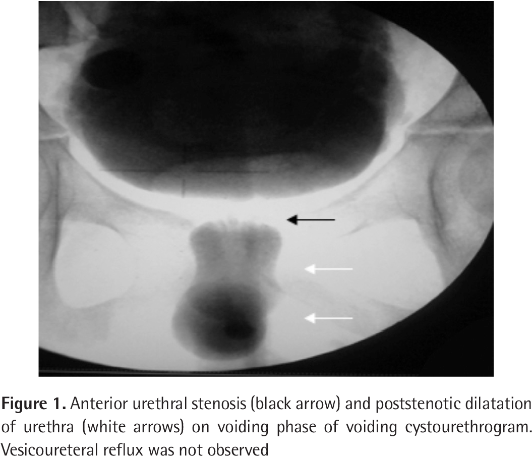 Cystourethroscopy Confirmed The Presence Of The Auv (1060x913), Png Download