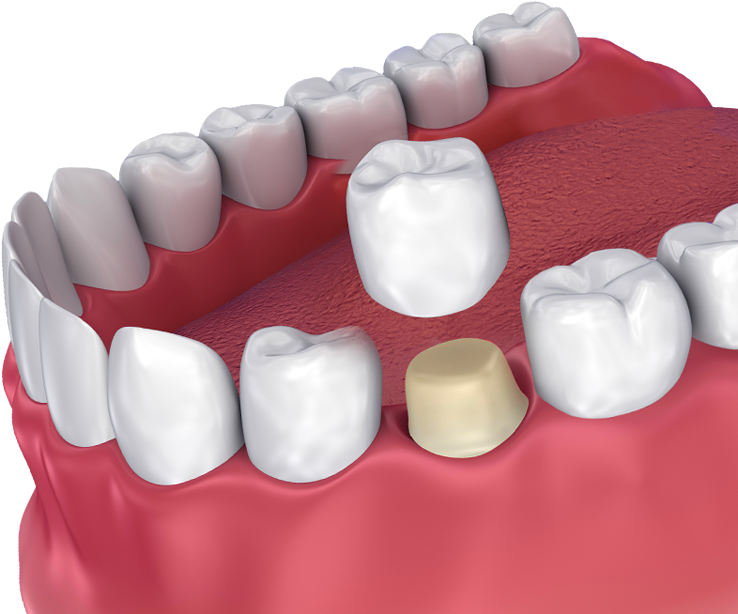 Dental Crown (800x946), Png Download