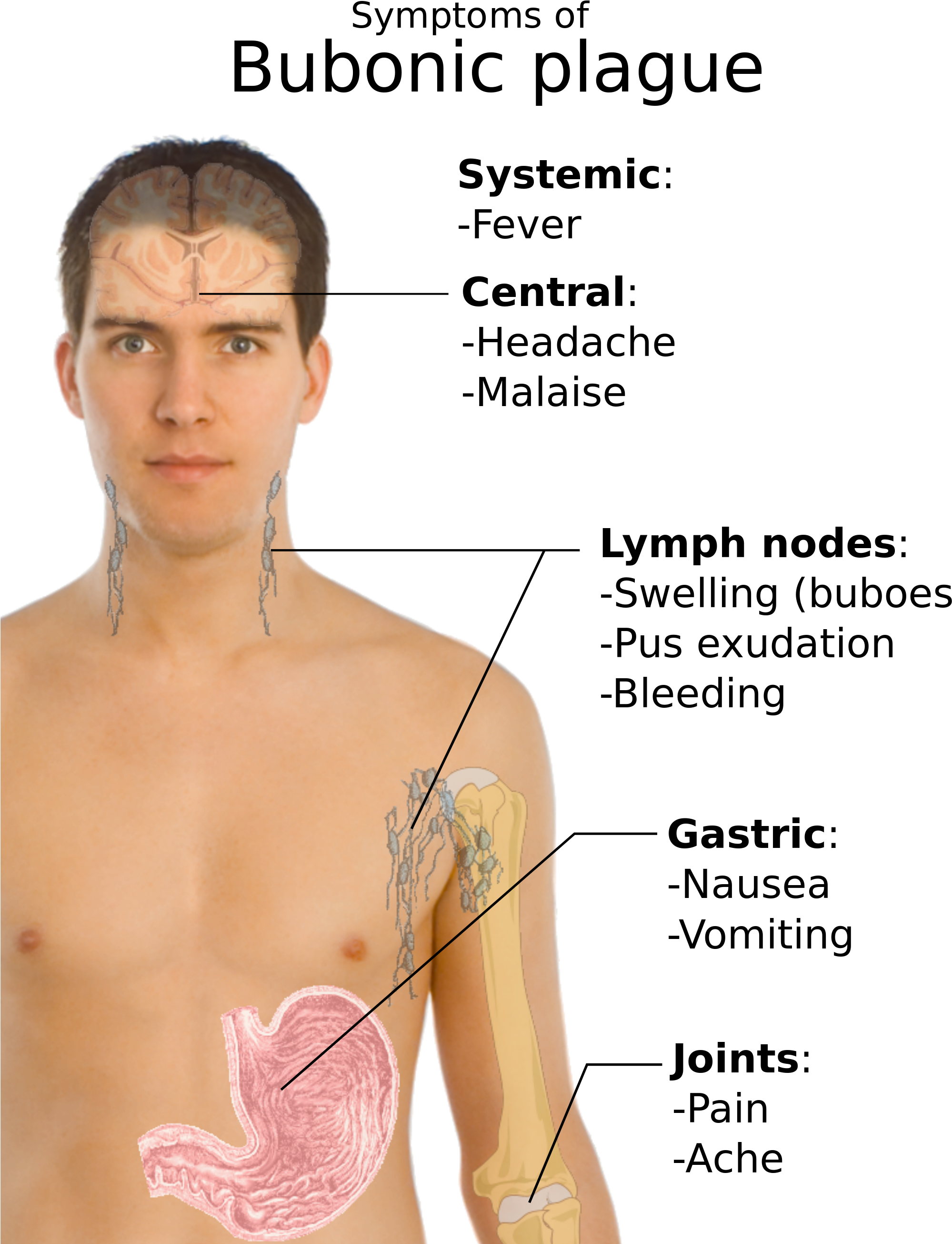 Open - Bubonic Plague Symptoms (2000x2632), Png Download