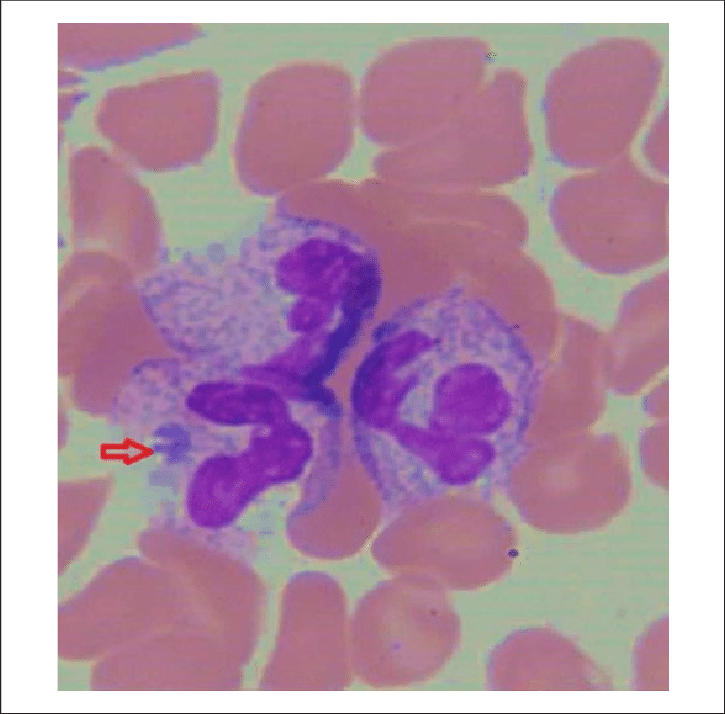Peripheral Smear From Hospital Day Showing Rare Morula - Morula Inclusions (725x714), Png Download