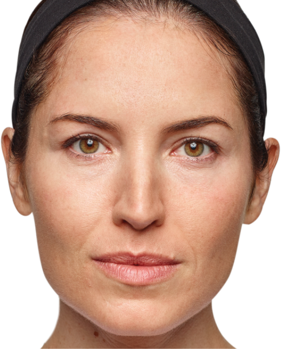 Woman Before And After Dysport Treatment - Dysport Injections (548x680), Png Download