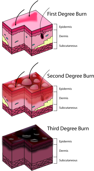 Degrees Of Burn (350x600), Png Download