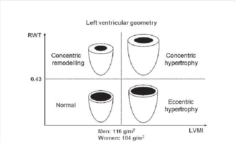 Left Ventricular Geometry Patterns (761x461), Png Download