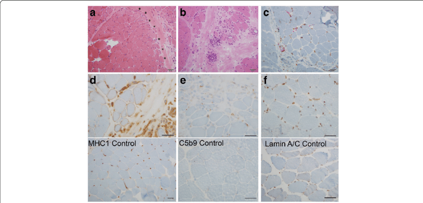 A Hematoxylin Eosin Staining Shows Prominent Perifascicular (850x408), Png Download
