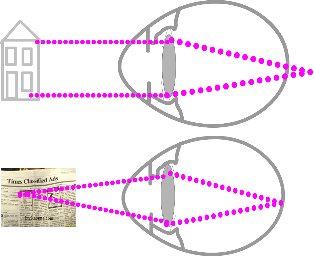 Opposite Of Myopia Medical Information And Advice (1000x817), Png Download