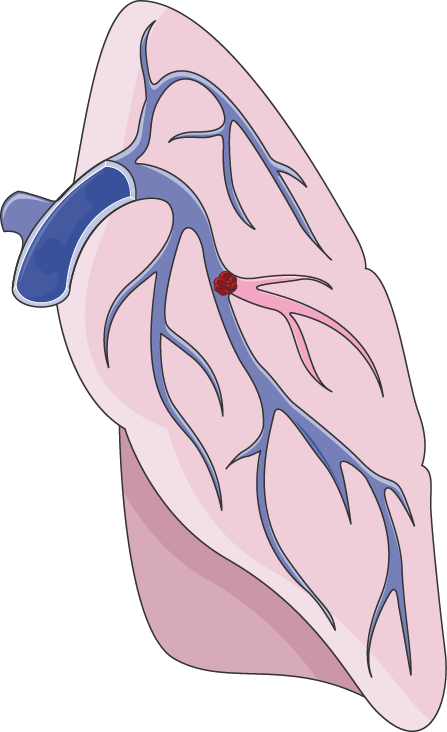 Pulmonary Embolism (447x732), Png Download