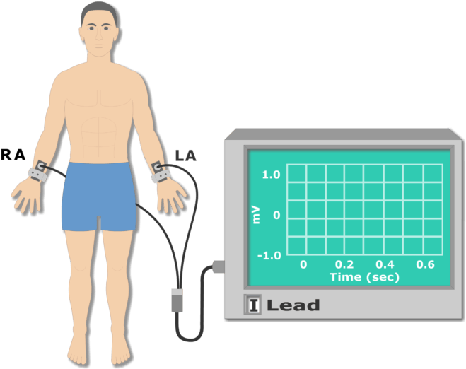 Left Arm Electrode Placement Animation Slide (666x550), Png Download