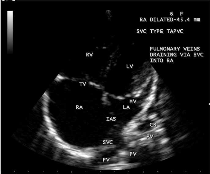 Svc Type Total Anamolous Pulmonary Venous Connection (903x568), Png Download