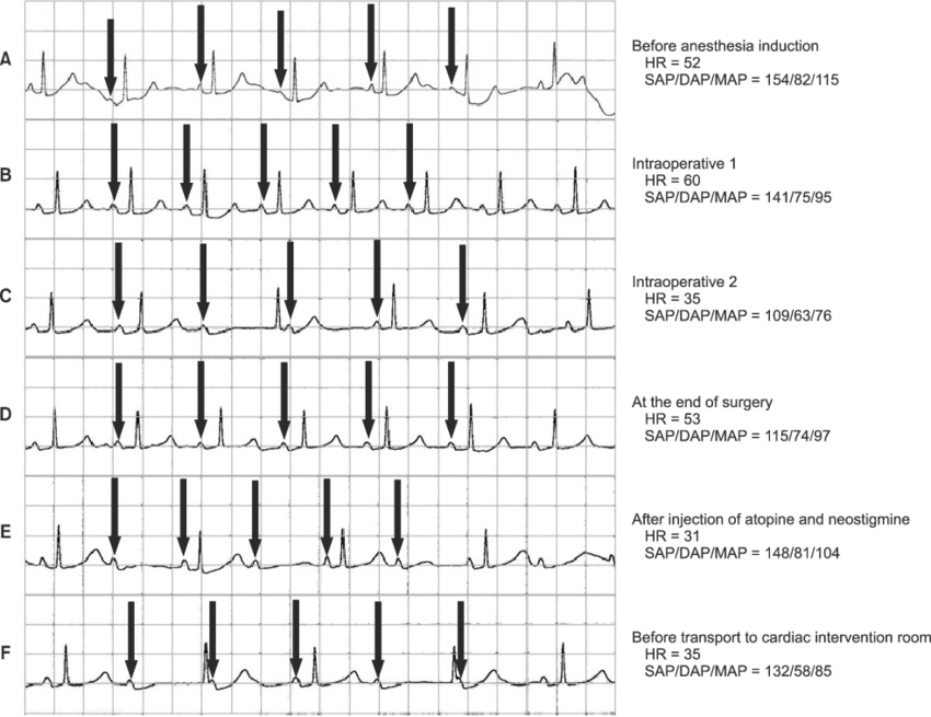 Electrocardiogram Waveforms And Vital Signs Were Retrieved (850x655), Png Download