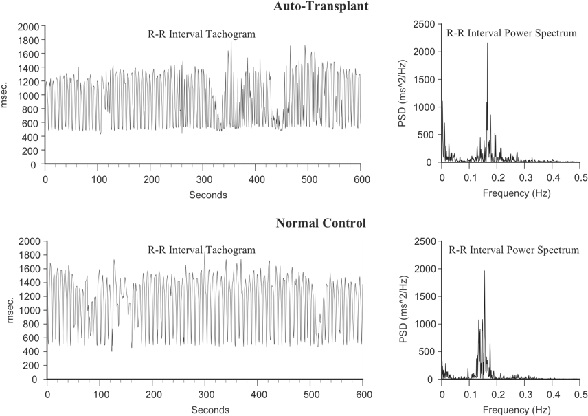 Heart Rhythms Generated By A Transplanted Heart At - Blood Pressure (875x611), Png Download