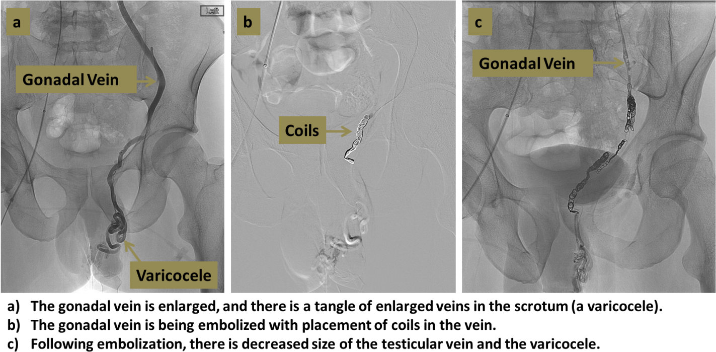 Varicocele Embolization Original - Varicocele Embolization (1464x719), Png Download