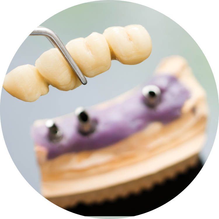 The Surrounding Teeth Deteriorate And It Is Just A (750x750), Png Download