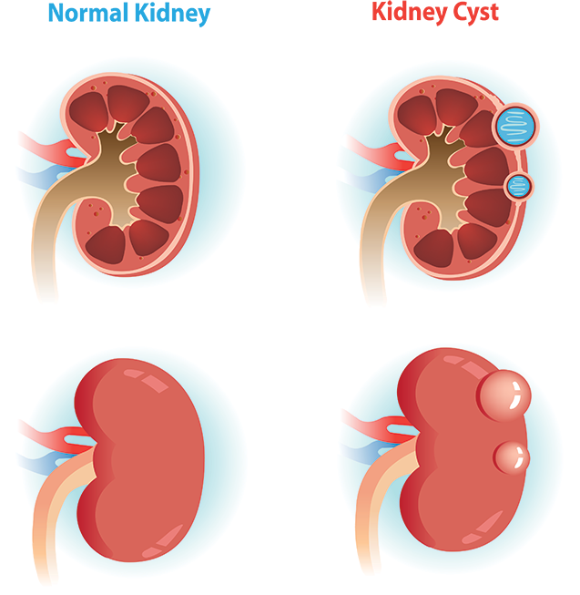 Are Kidney Cysts Rare (637x653), Png Download