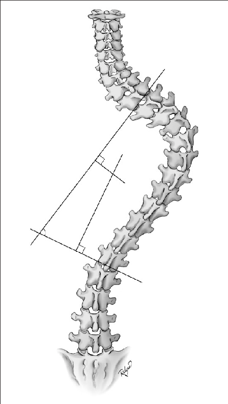 Measurement Of The Cobb Angle (448x794), Png Download
