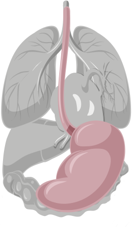Stomach Cancer, Or Gastric Cancer, Is Due To An Abnormal - Illustration (400x458), Png Download
