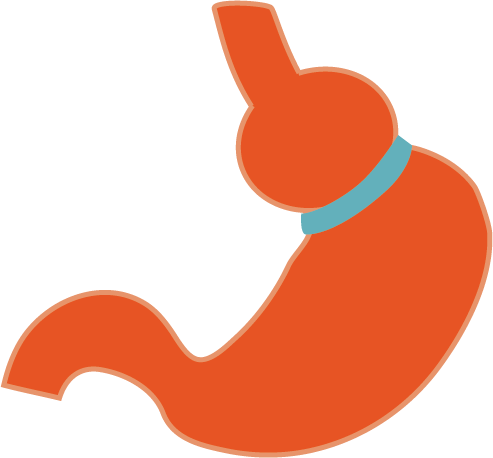 Laparoscopic Adjustable Gastric Band Is A Type Of Weight - Adjustable Gastric Band (493x458), Png Download