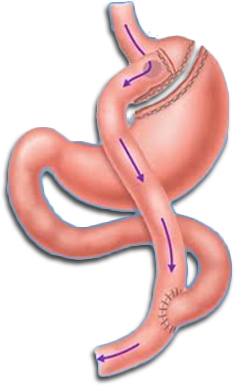 Bmi Calculator - Weight Loss Bypass Surgery (388x429), Png Download