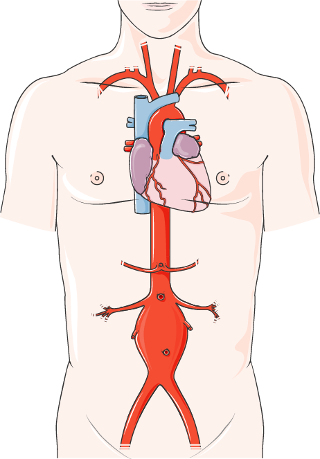 Abdominal Aortic Aneurysm - Cardiac Catheter Procedure (462x663), Png Download