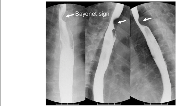 Upper Gastrointestinal Series Showed The Bayonet Sign, (850x410), Png Download
