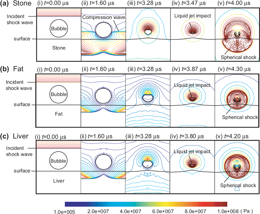 Bubble Collapse Near Stone, Fat, And Liver Boundaries (850x709), Png Download