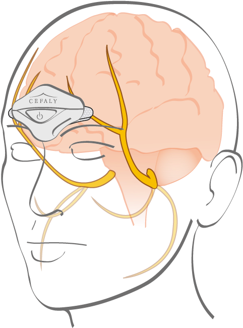 Treatment And Prevention Of Miraine (612x792), Png Download