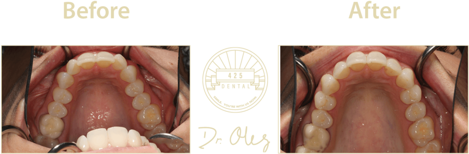 425 Before After Invisaline15 (1000x462), Png Download