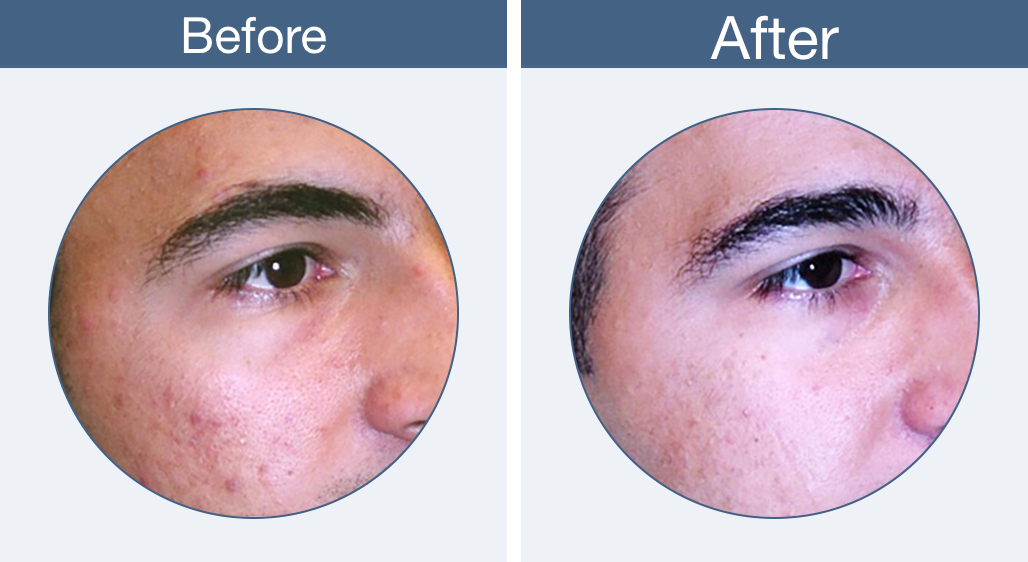 Clearogen Before & After (1028x562), Png Download