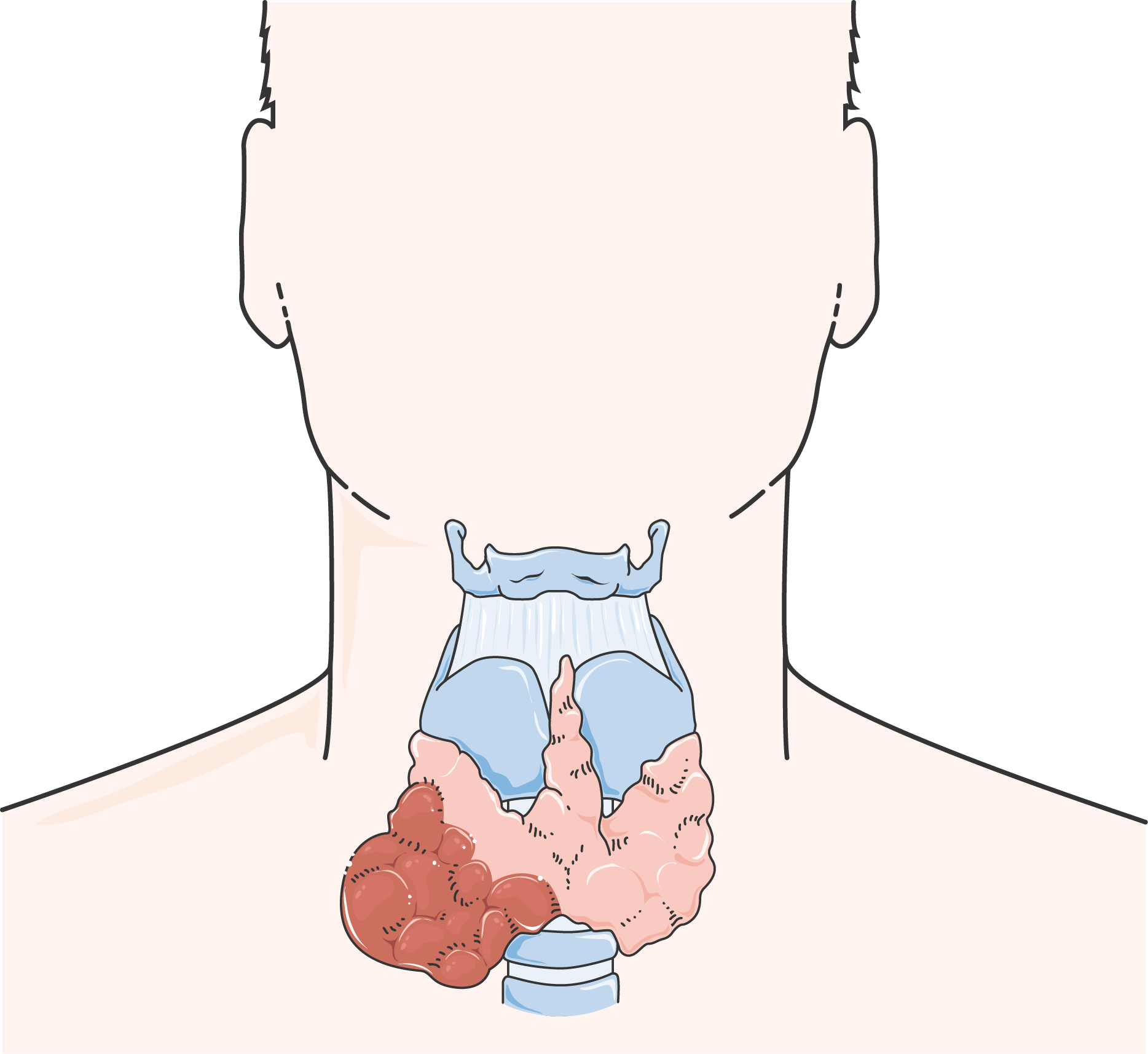 Cancer De La Thyroïde (1868x1715), Png Download