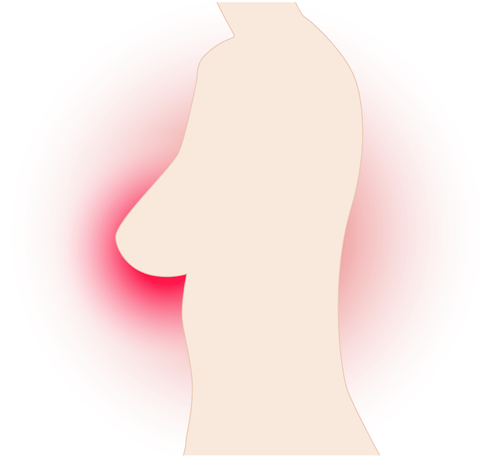 Breast,breast Cancer,cancer,breast Cancer - ภาพ มะเร็ง เต้า นม Png (1280x982), Png Download