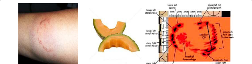 Images Shows Different Bite Marks On Human Skins And - Human Bite Marks (850x216), Png Download