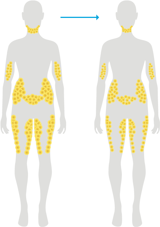Fat Cells After Typical Weight Loss - Man (574x804), Png Download