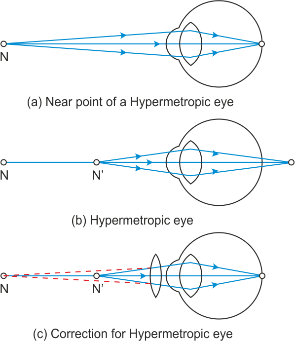 Presbyopia - Diagram (598x691), Png Download