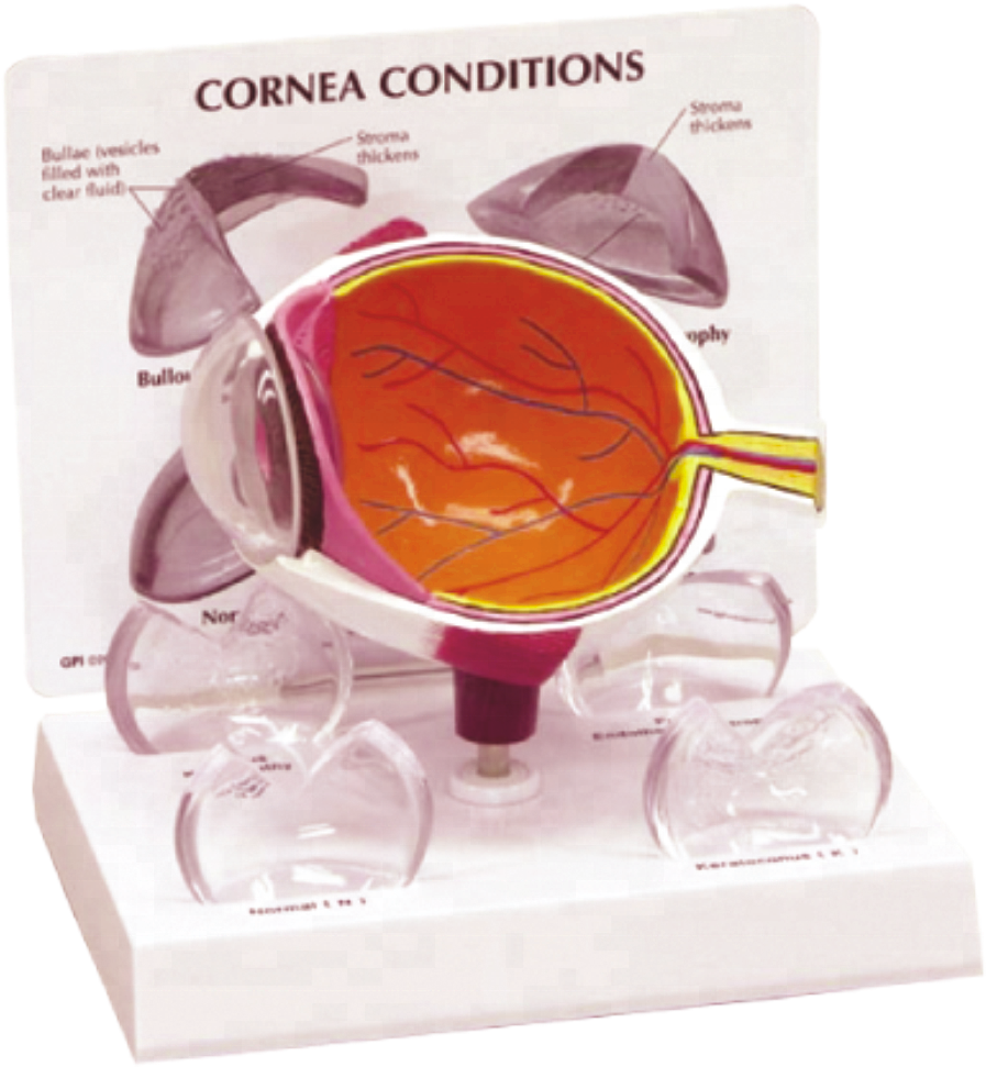 Human Eye Model With Pathological Cornea - Cornea On A Model (970x970), Png Download