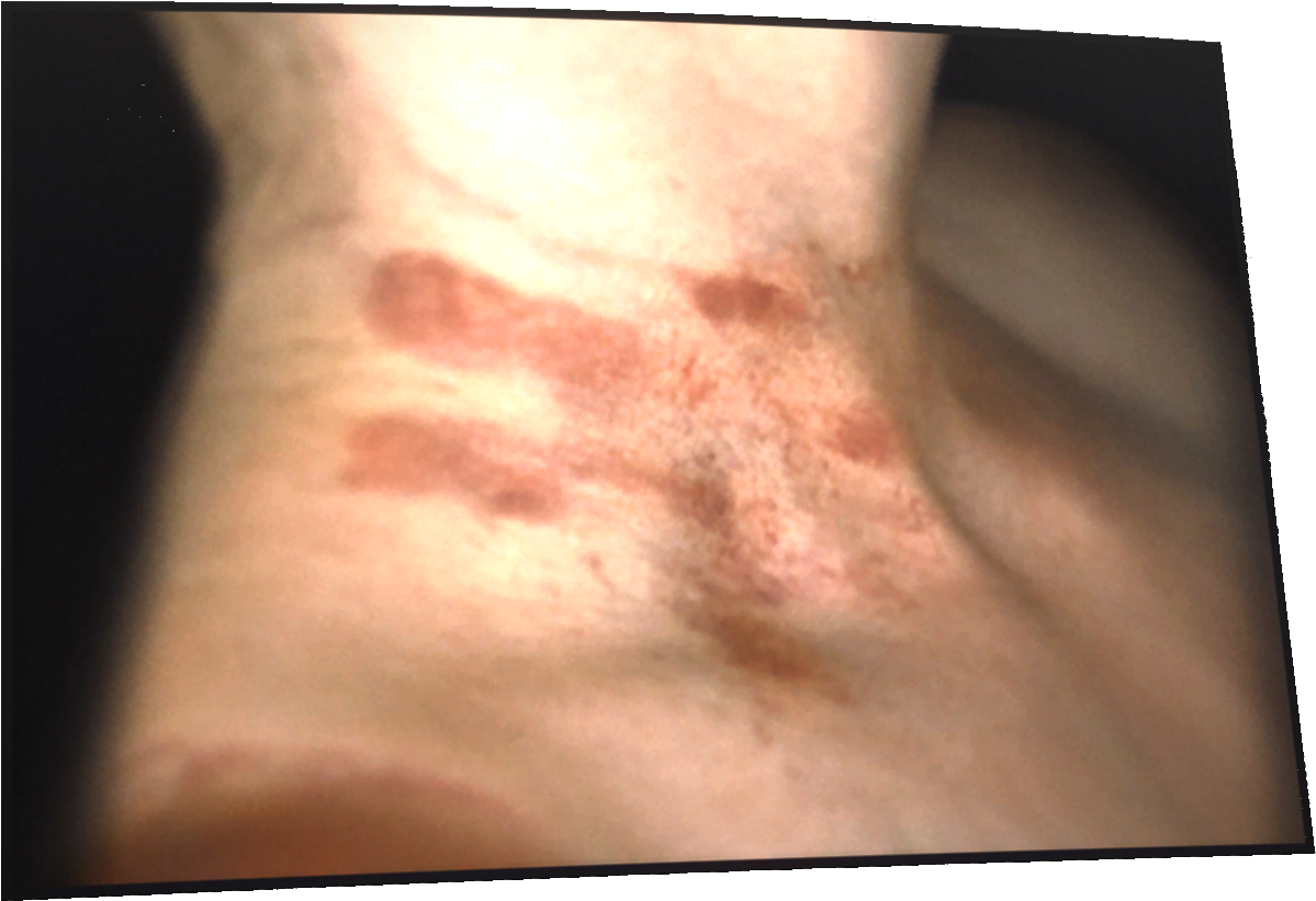 Bruises Png (1420x870), Png Download