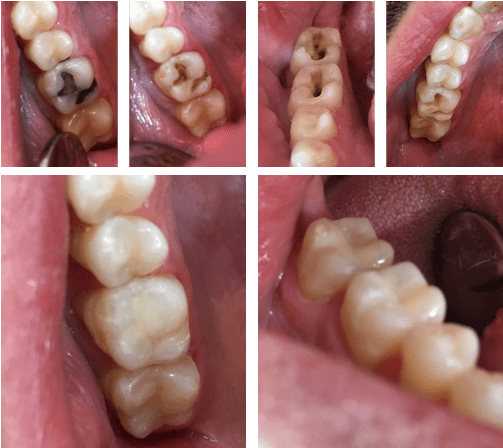 Utica Dental Fixing Old Mercury Fillings - Macro Photography (502x634), Png Download