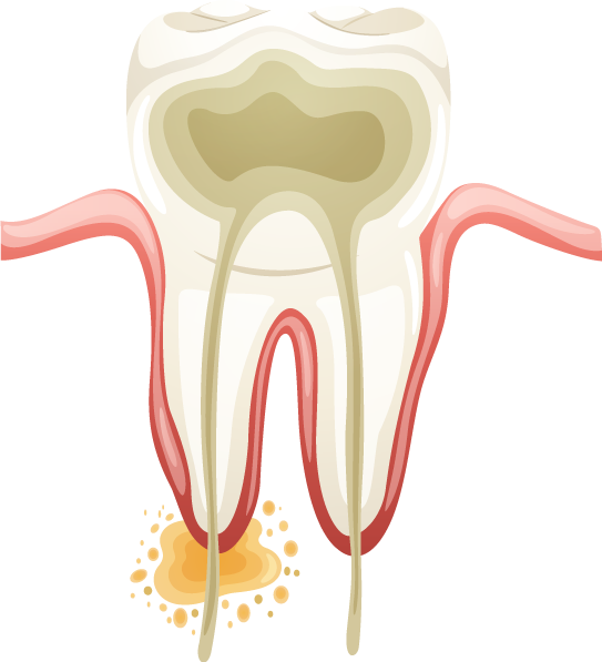 Root-canal1 - Endodontic Vector (543x597), Png Download