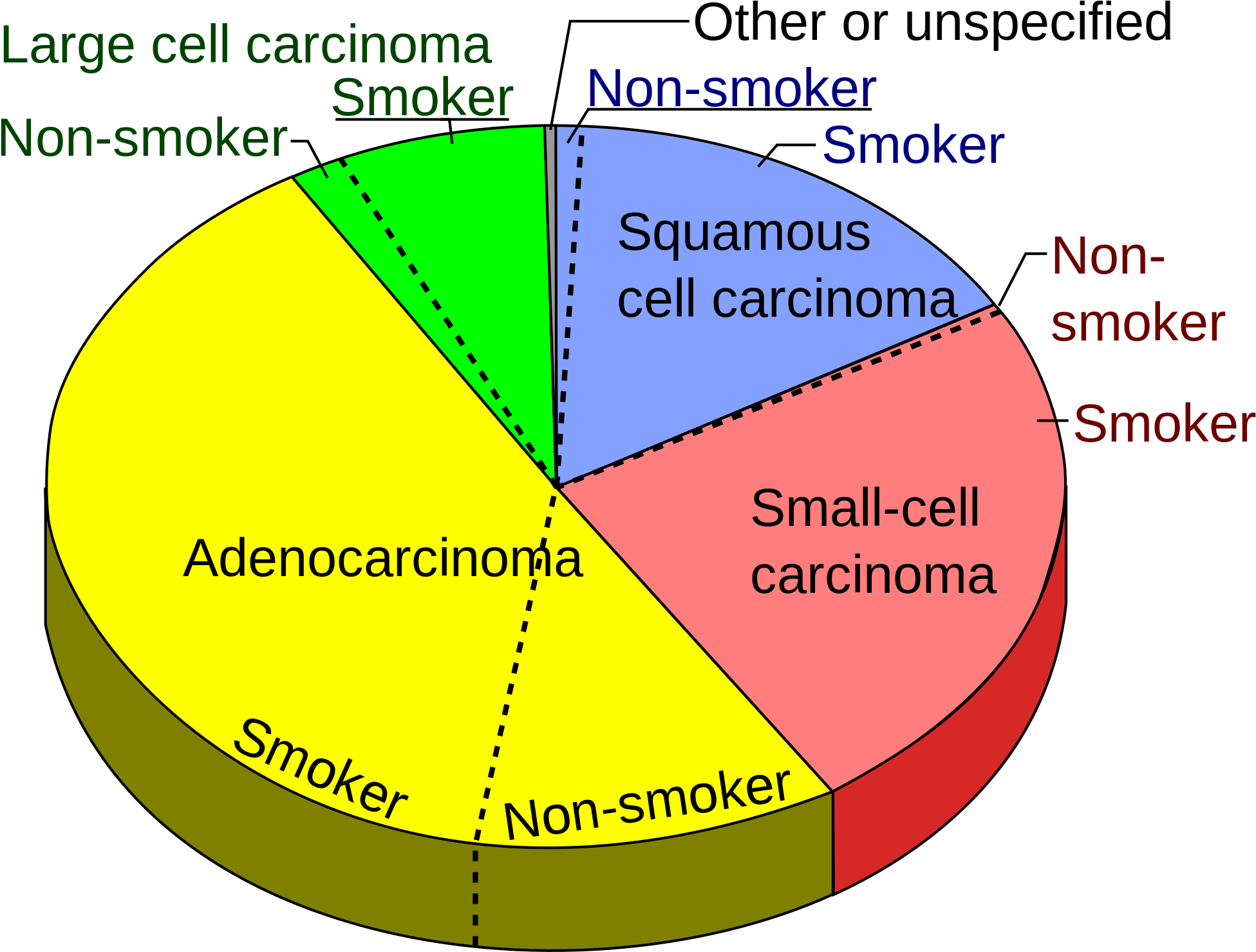 Lung Cancer Pie Chart (2000x1527), Png Download