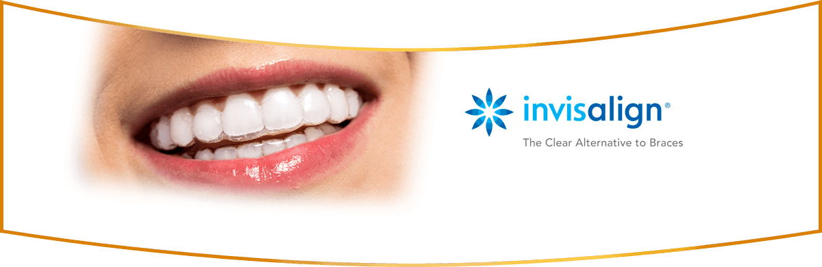 Invisalign San Luis Obispo Ca - Clear Aligners (1200x390), Png Download