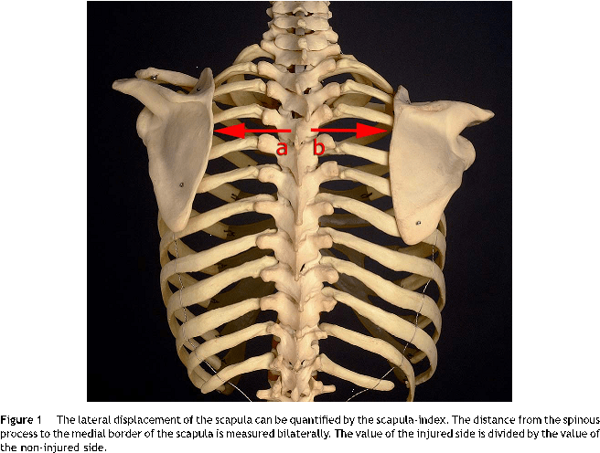 Ct Imaging May Demonstrate Widening Of The Scapulothoracic - Rib (759x527), Png Download