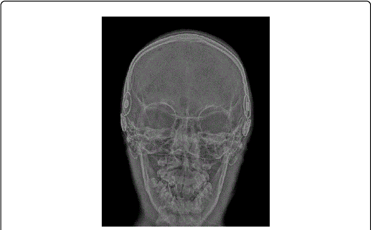 Plain Trans Orbital Skull Film Taken Intra Operatively - Medical Imaging (769x475), Png Download