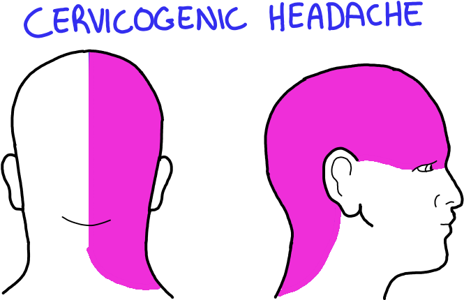 Cervicogenic-headache - Cervicogenic Headache (800x463), Png Download