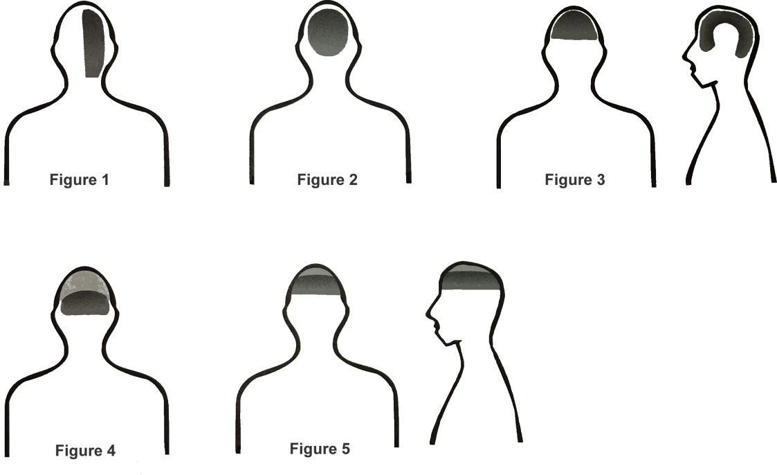 Headaches - Tight Band Feeling Around Head (1123x686), Png Download