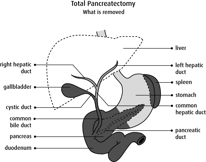 Diagram Of What Is Removed In A Total Pancreatectomy - Pancréatectomie Totale (675x532), Png Download